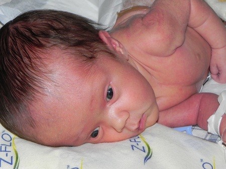 Wide awake before surgery