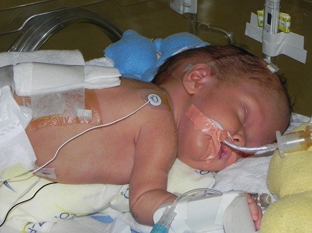 After surgery 
